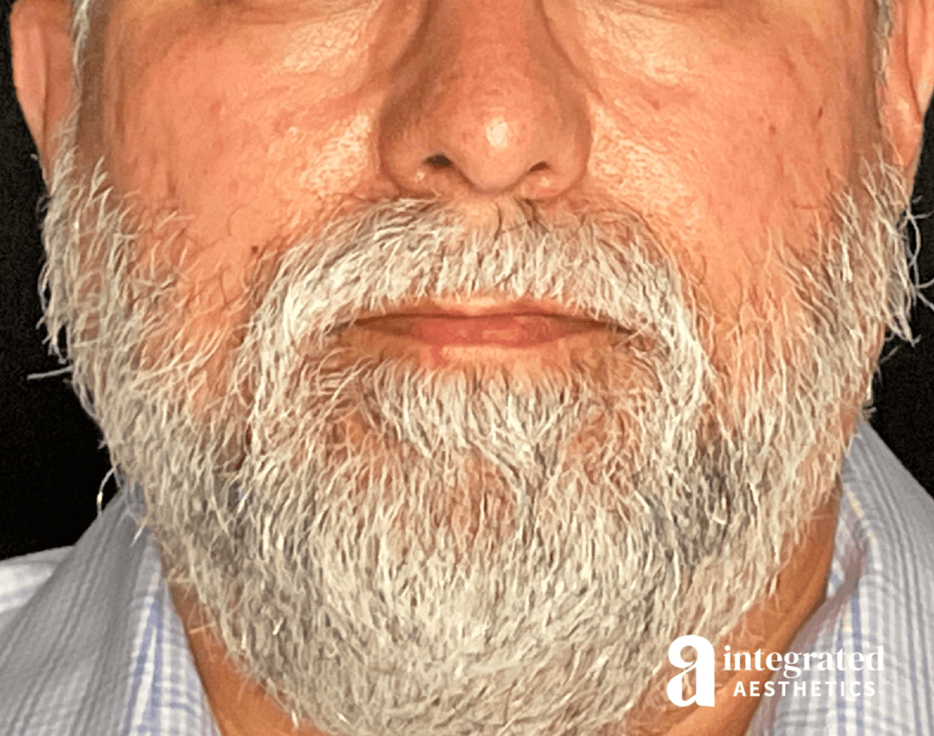 Microneedling and Sculptra