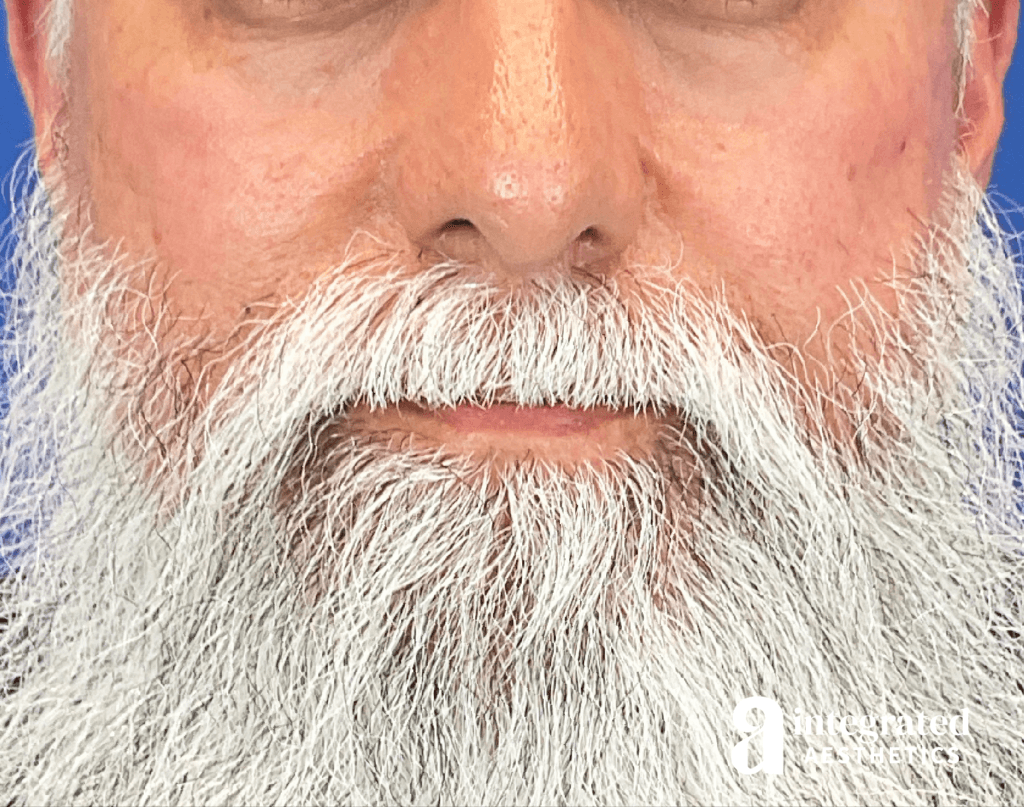 Microneedling and Sculptra