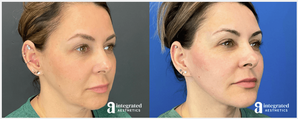 43-year-old facelift case study of female patient by Woodlands plastic surgeon Dr. Young Cho