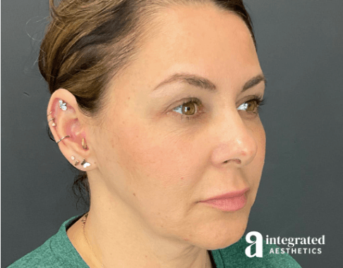 43-year-old patient by Woodlands plastic surgeon Dr. Young Cho before facelift